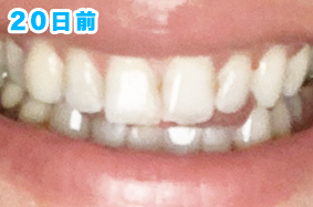 歯のホワイトニングビローアフター